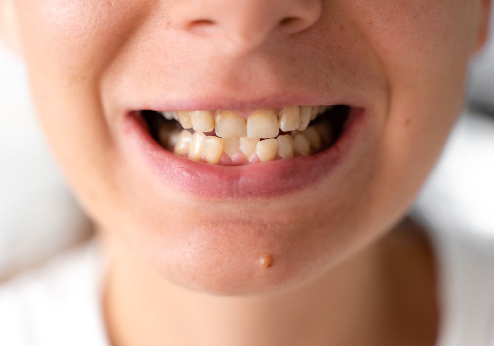 Can diet and oral hygiene affect natural tooth color?