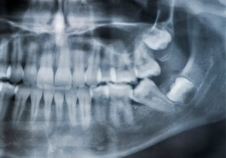 Can Impacted Wisdom Teeth Shift Other Teeth? (Potential Risks)