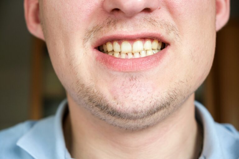 Teeth Discoloration: Can Iron Deficiency Be the Culprit?