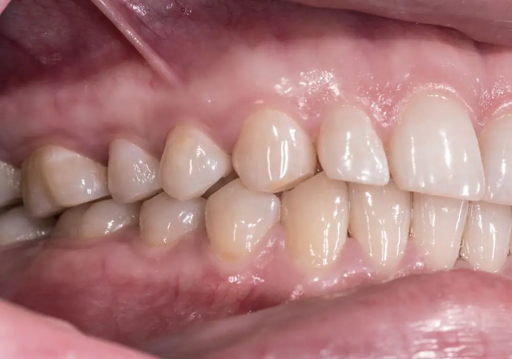 Can mildly shifted teeth recover position?