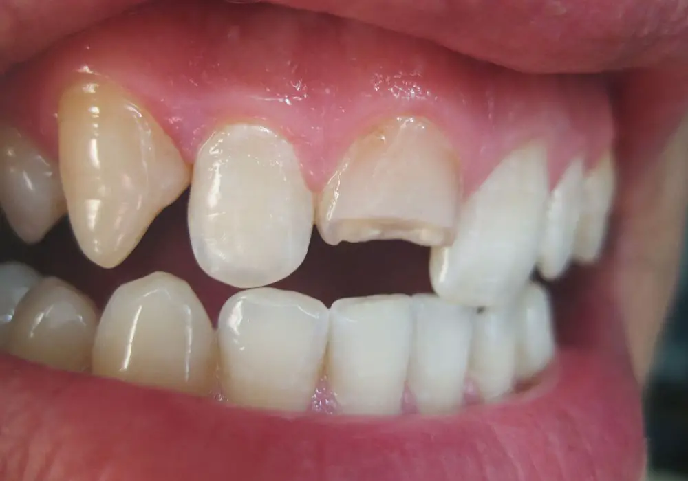 Can small chips in teeth be fixed