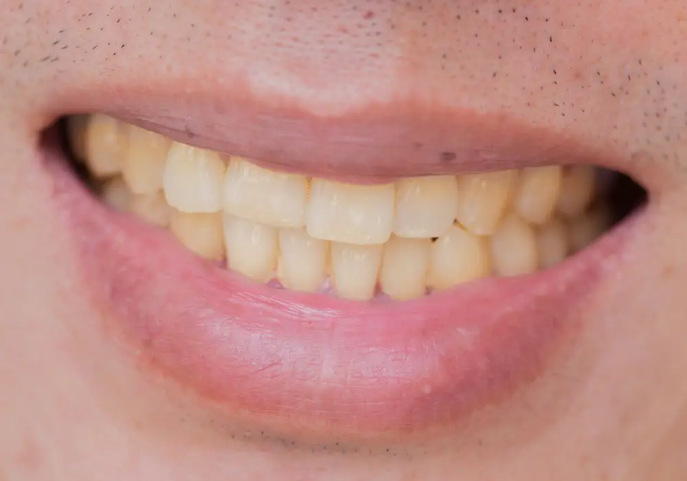 Can stained teeth return to normal color
