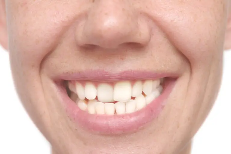 Can Teeth Go From Straight To Crooked? (7 Contributing Factors)