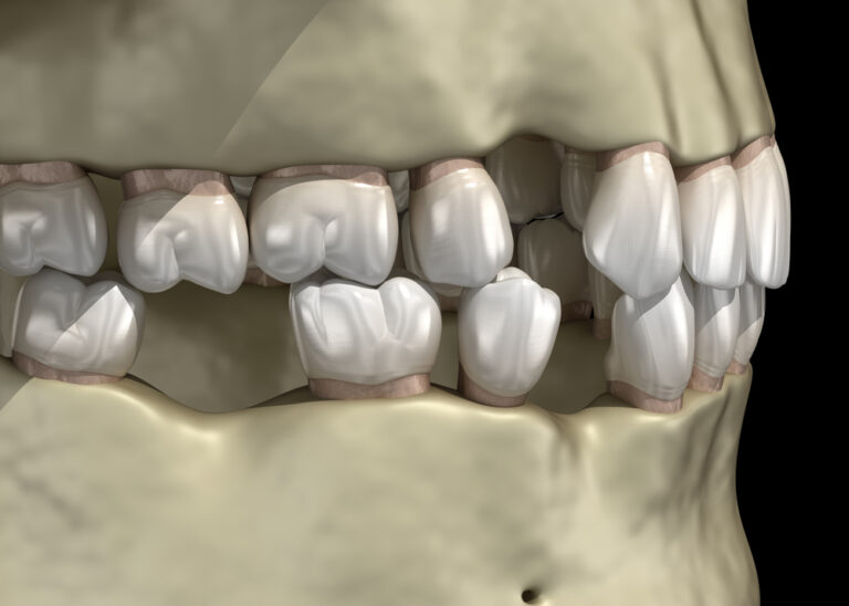 Can teeth shift in a few days? what are the causes?