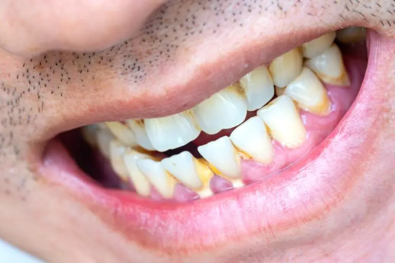 Can Tooth Calcification Be Reversed? (A Comprehensive Guide)