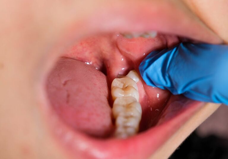 Can wisdom teeth cause permanent damage? (Explained)