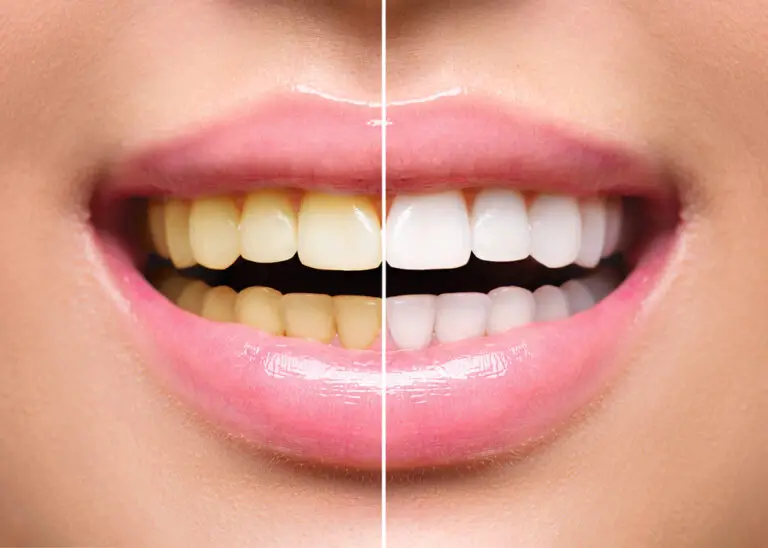 Can you Photoshop yellow teeth? (with Step-by-step guide)