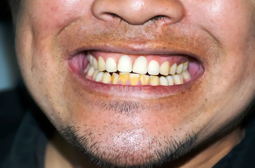 Fixing Yellow Teeth from Smoking Tips and Tricks