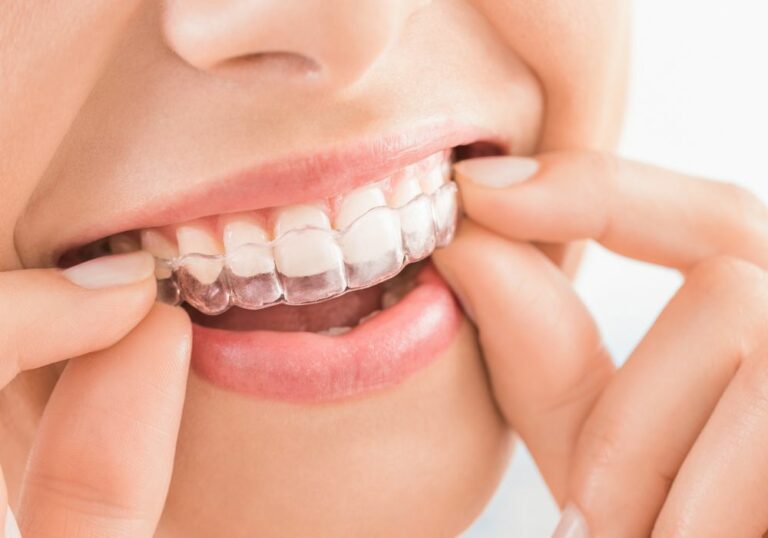 Can You Get Invisalign Just For Front Teeth? (Pros & Cons)