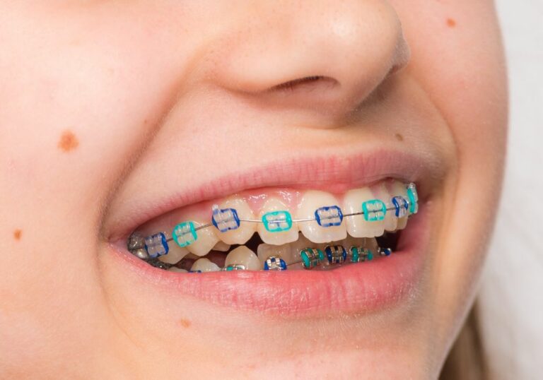 Can You Get Braces with a Half Fake Tooth? (Caring Tips)