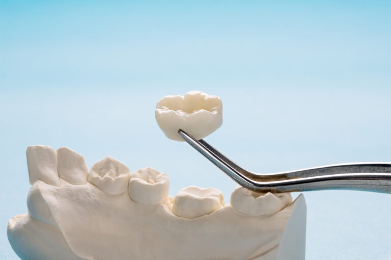 White Caps for Teeth: An Alternative to Silver?