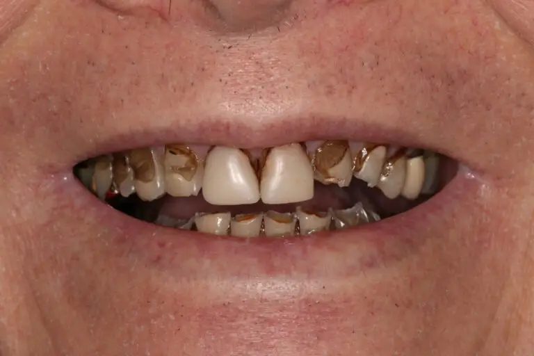 Can You Make Black Teeth White Again? (Causes & Treatments)