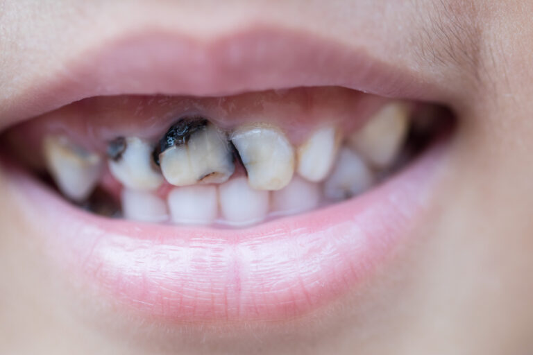 Can You Remove Black Decay From Teeth? (Removal Options & Prevention)