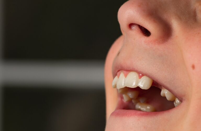 Can You Use Gorilla Glue On A Tooth? (Other Alternative Options)