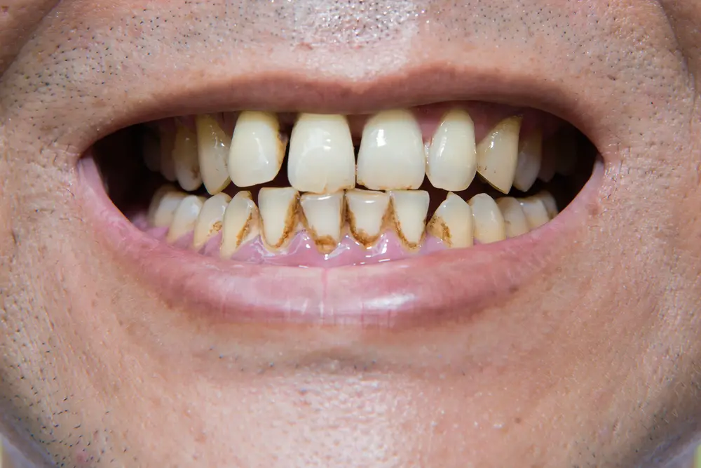 Home Remedies For Smoke Stained Teeth at Stephanie Hamilton blog