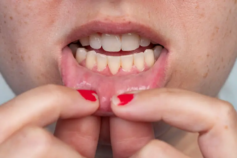 Can Your Gums Heal from Gum Recession? Exploring the Possibilities.