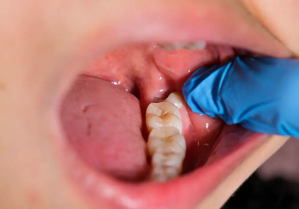 Causes and Risk Factors for Loose Wisdom Teeth