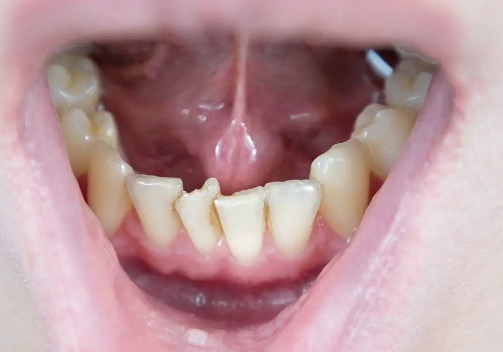 Causes of Crooked Bottom Teeth