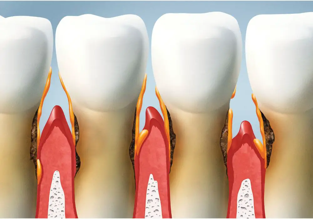 Causes of Gum and Bone Loss