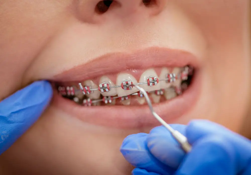 Causes of Teeth Staining with Braces