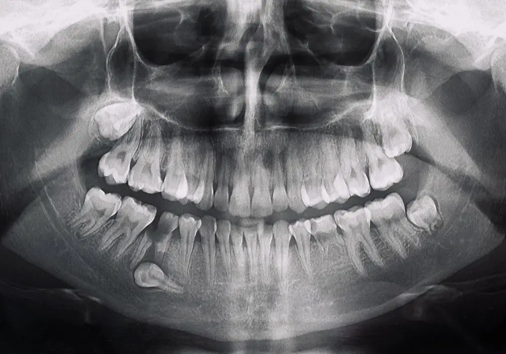 Causes of Tooth Bone Loss