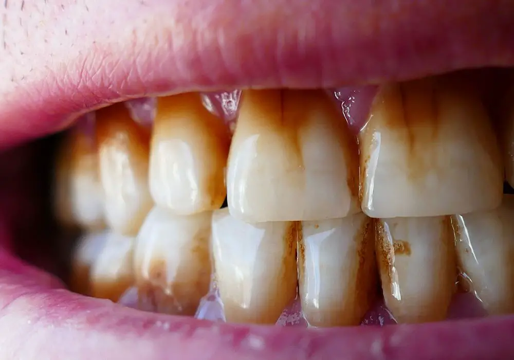 Common Causes of Brown Tooth Stains