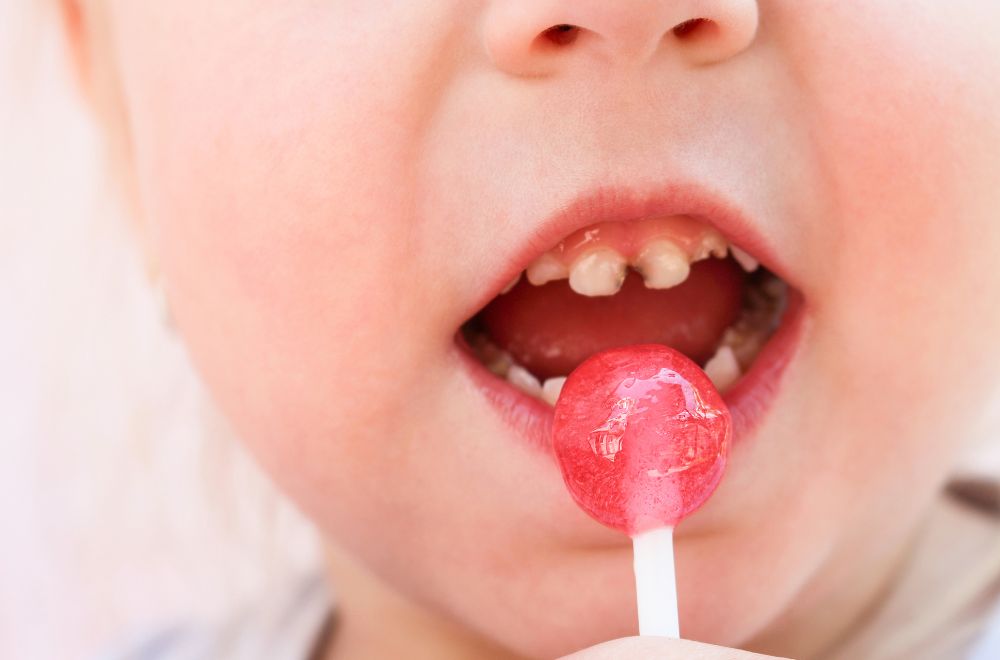 Common Causes of Tooth Decay