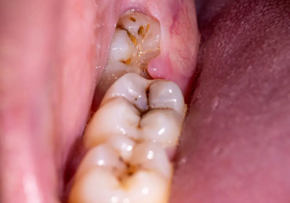 Common Causes of Wisdom Tooth Pain