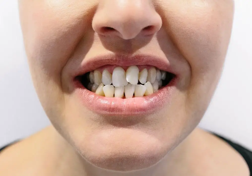 Common Orthodontic Treatment Options for Crowded Teeth