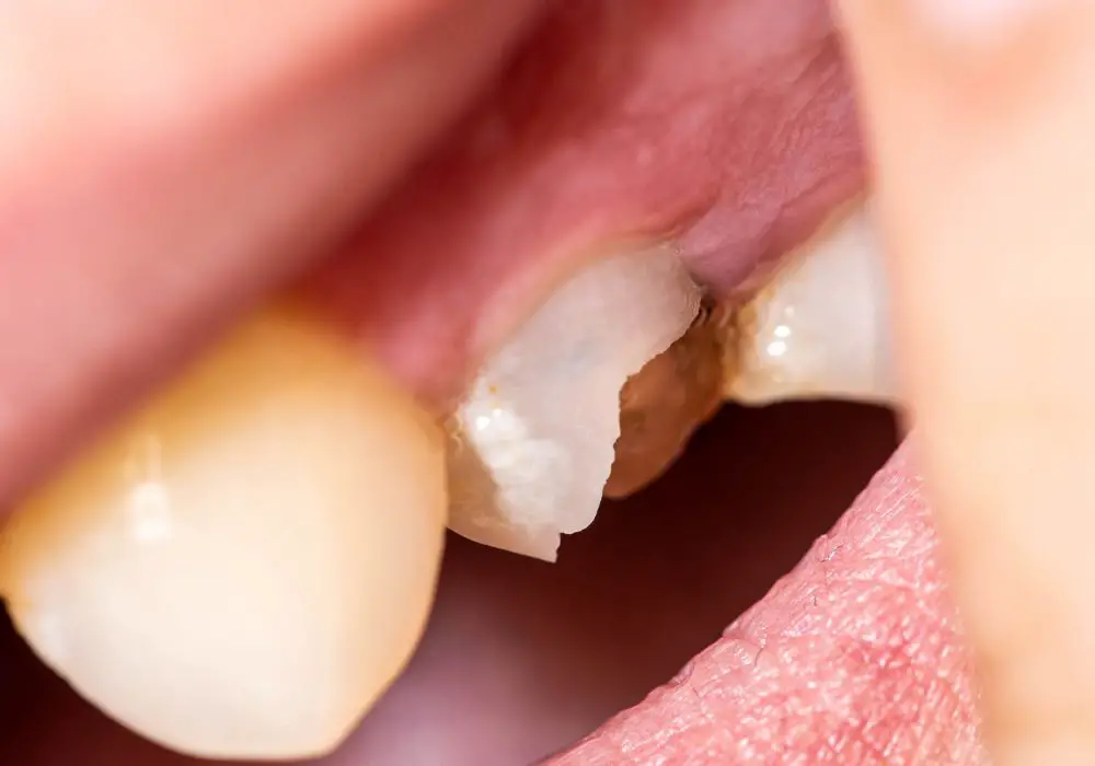 Consequences of Cracked and Chipping Teeth