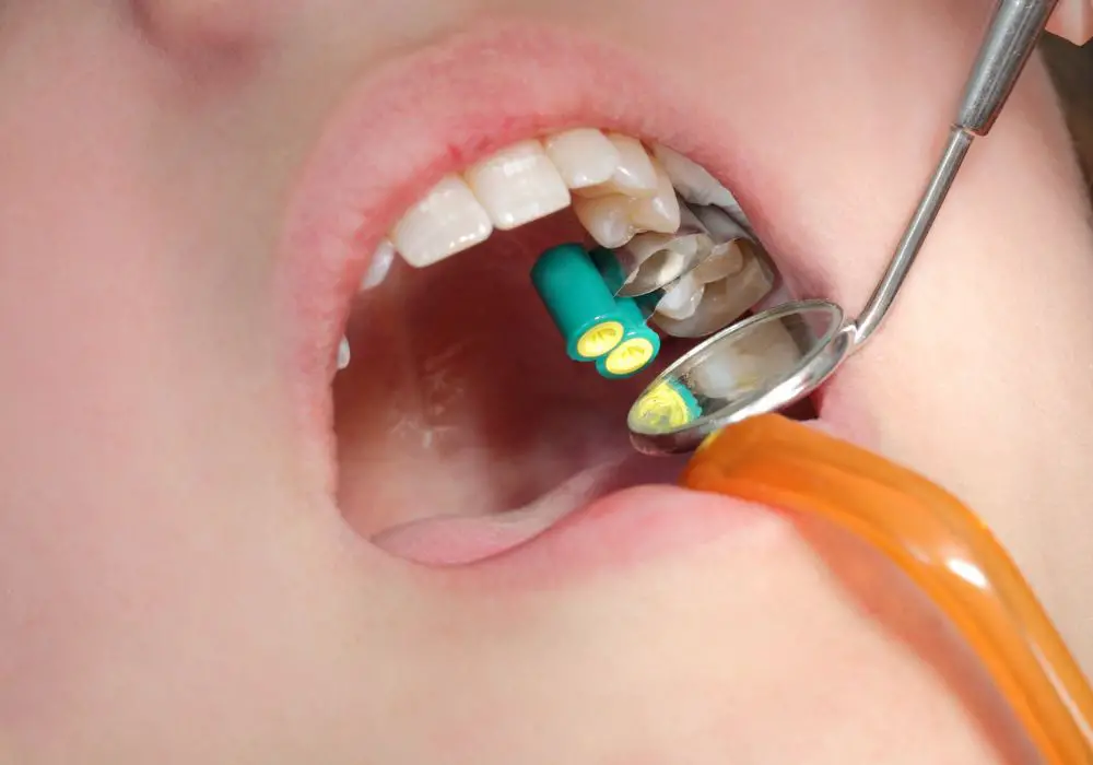 Conventional Treatments Used by Dentists for Cavities