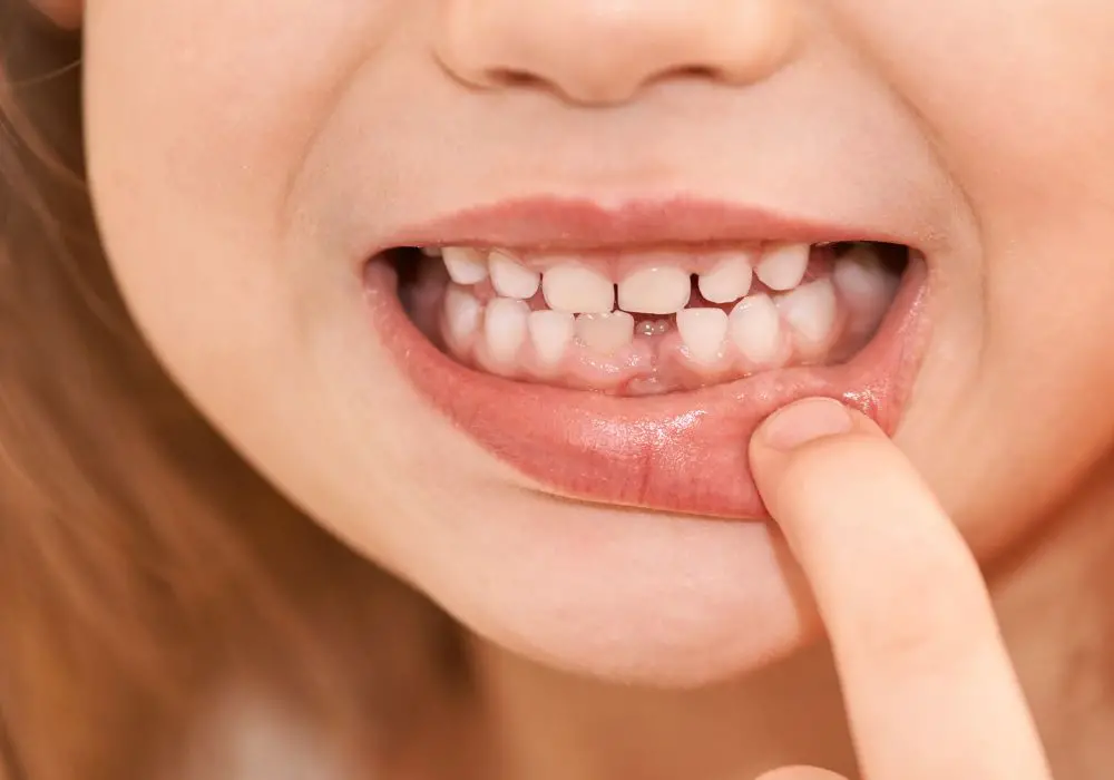 Cosmetic Concerns About Tooth Gaps