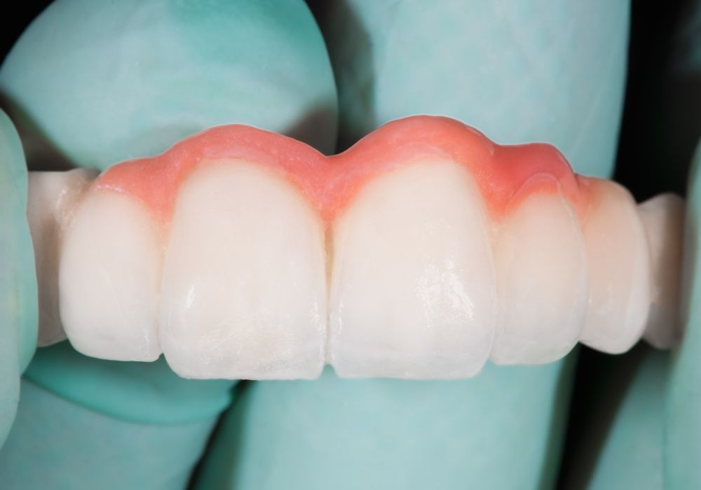 Dental Bridges