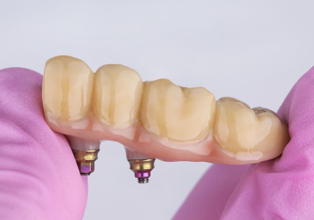 Dental Bridges