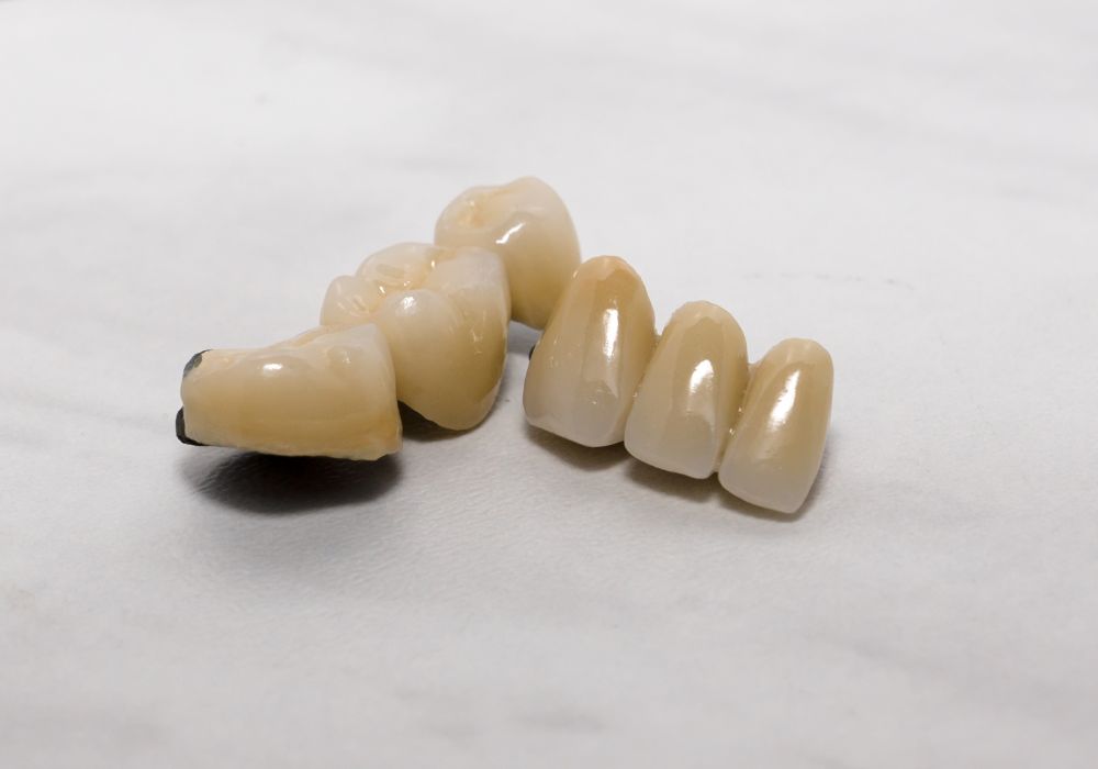 Dental Crowns and Bridges