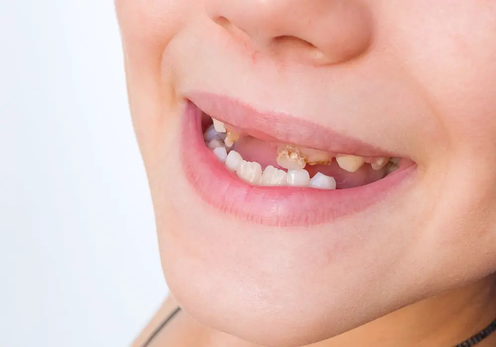 Dental issues that can cause tooth breakage