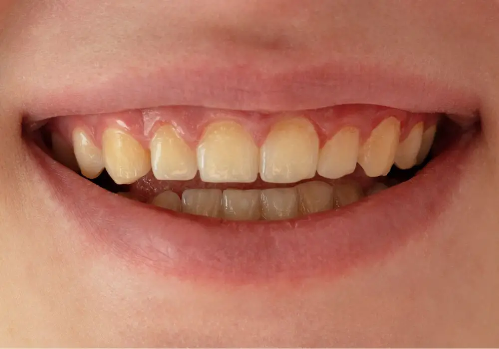 Dentist treatments for gray teeth