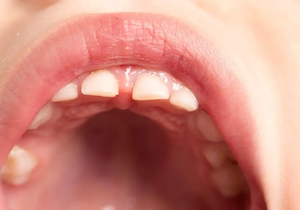 Detailed stages of natural root resorption