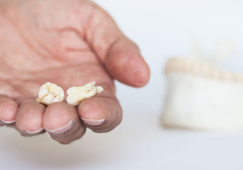 Details of Wisdom Tooth Extraction Surgery