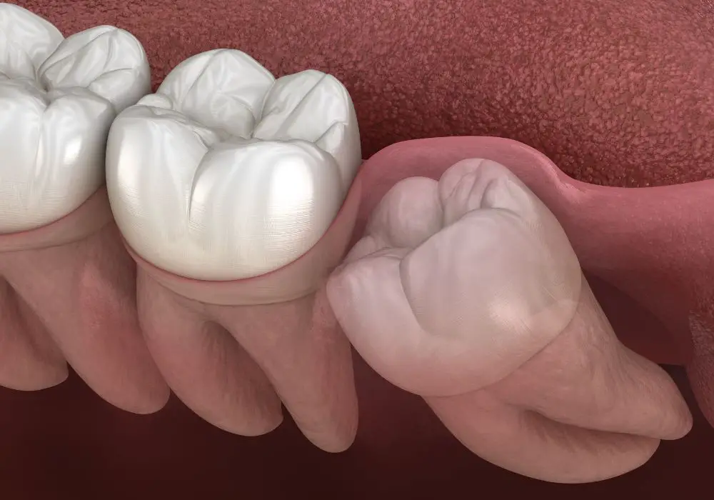 Do wisdom teeth hold neighboring teeth in place?