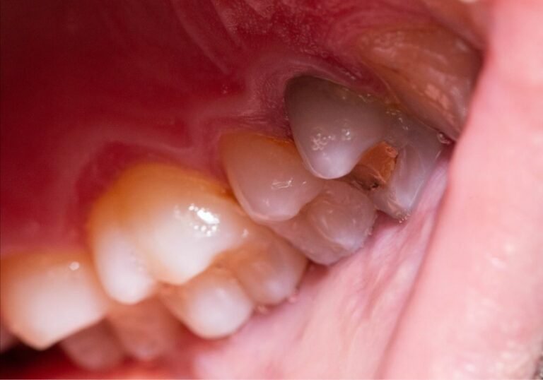 Can A Dentist See A Dead Tooth On An Xray? (Detection & Diagnosis)