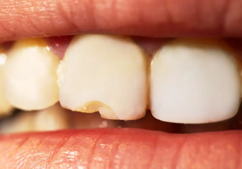 Does insurance cover chipped tooth repair?