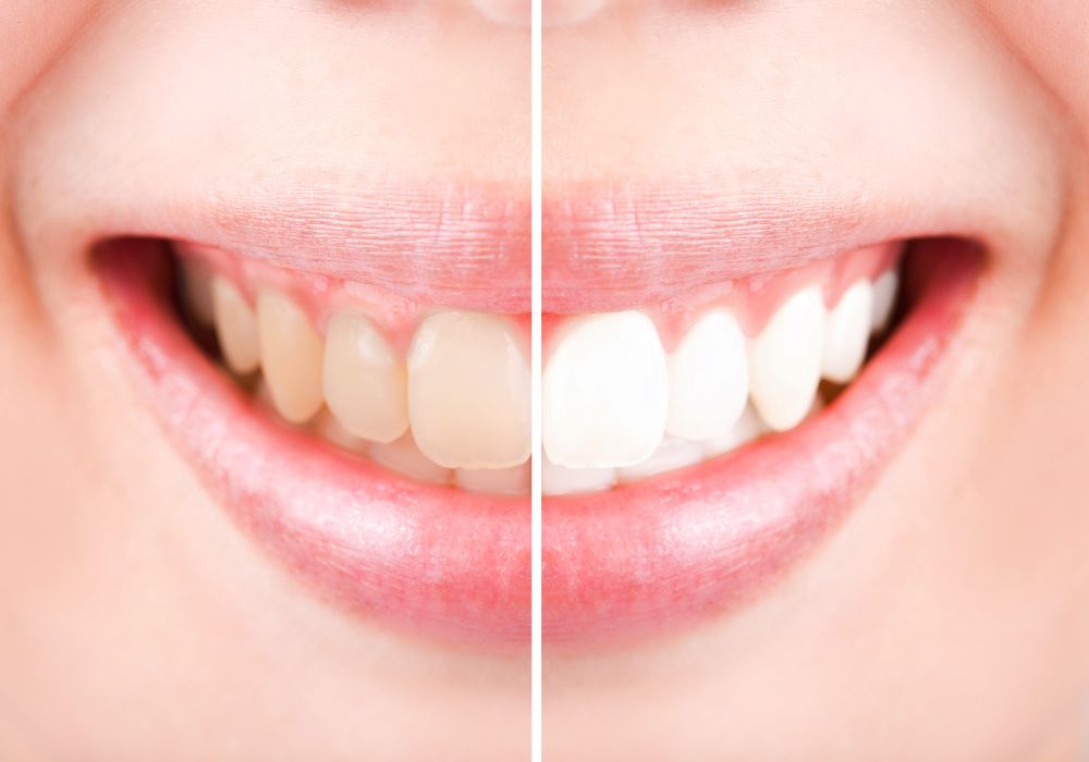 Effective Ways To Whiten and Brighten Greyish Teeth