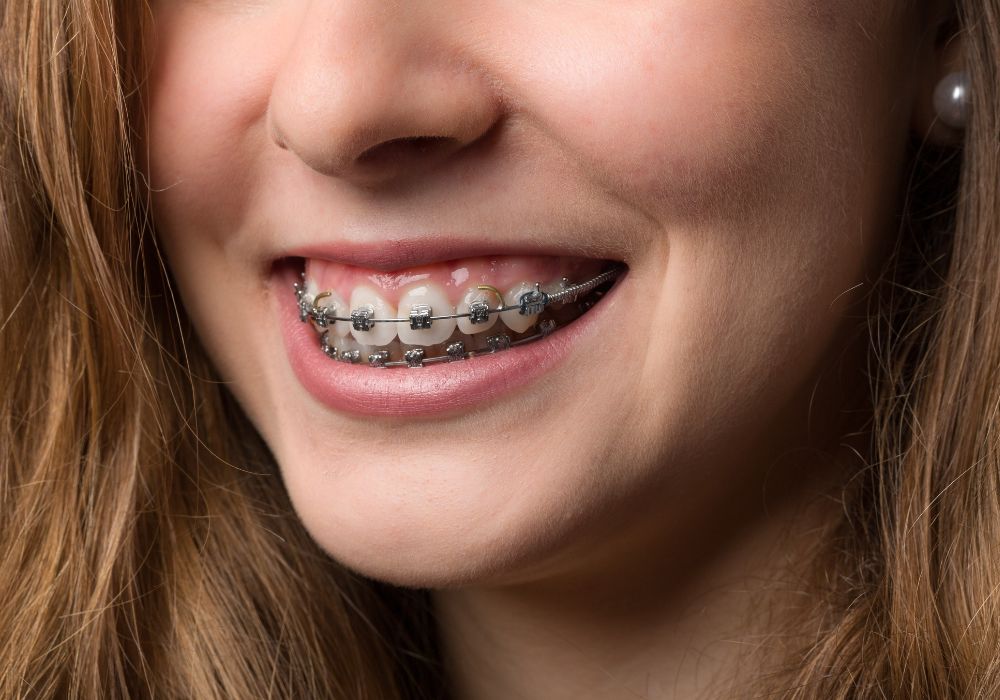 Eligibility for Braces