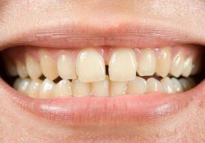 Why Does Madonna Have A Gap In Her Teeth? (Variety Theories)