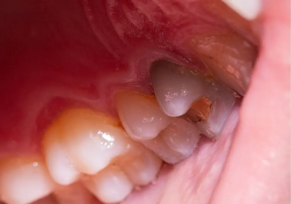 Factors Influencing Tooth Discoloration After a Root Canal