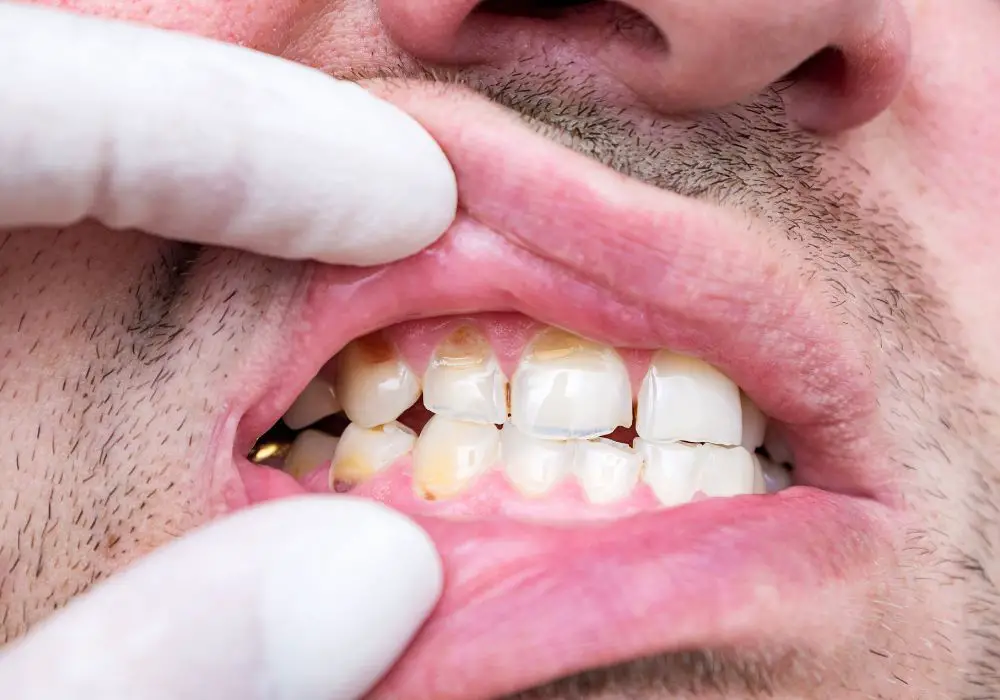 Factors that increase your risk of crumbling teeth