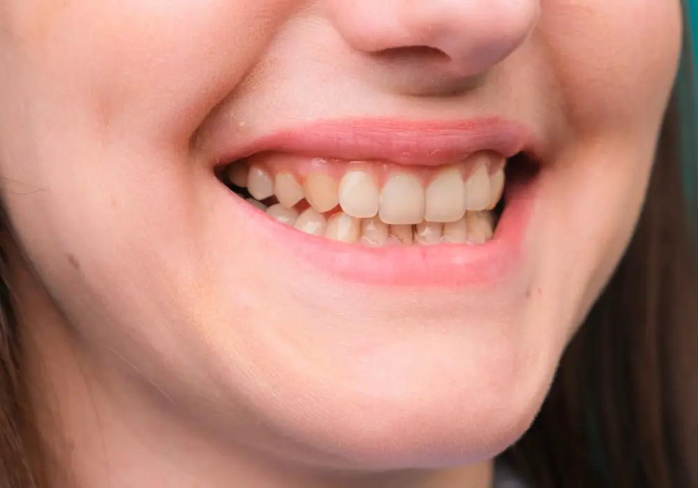 Factors that influence tooth yellowing