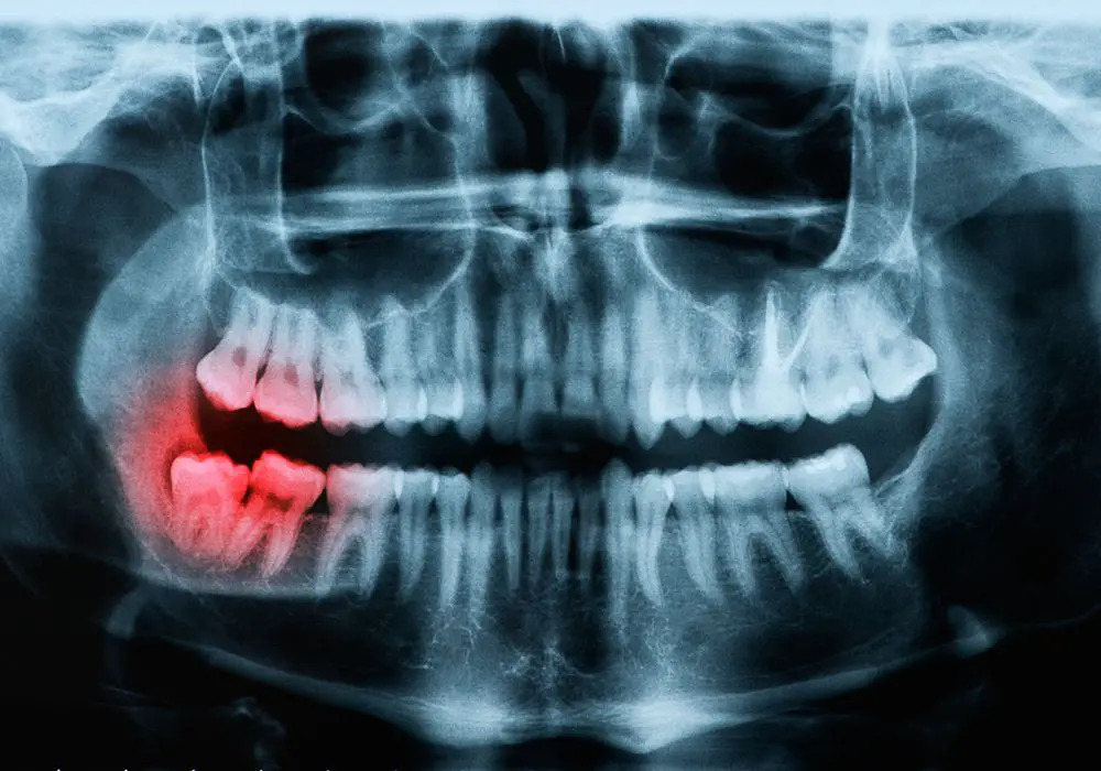 Fasting prevents complications during the procedure