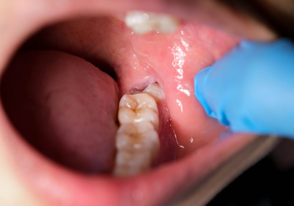 First aid tips to stop wisdom tooth bleeding